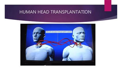 human head transplant results|First Human Head Transplantation: Surgically Challenging, .